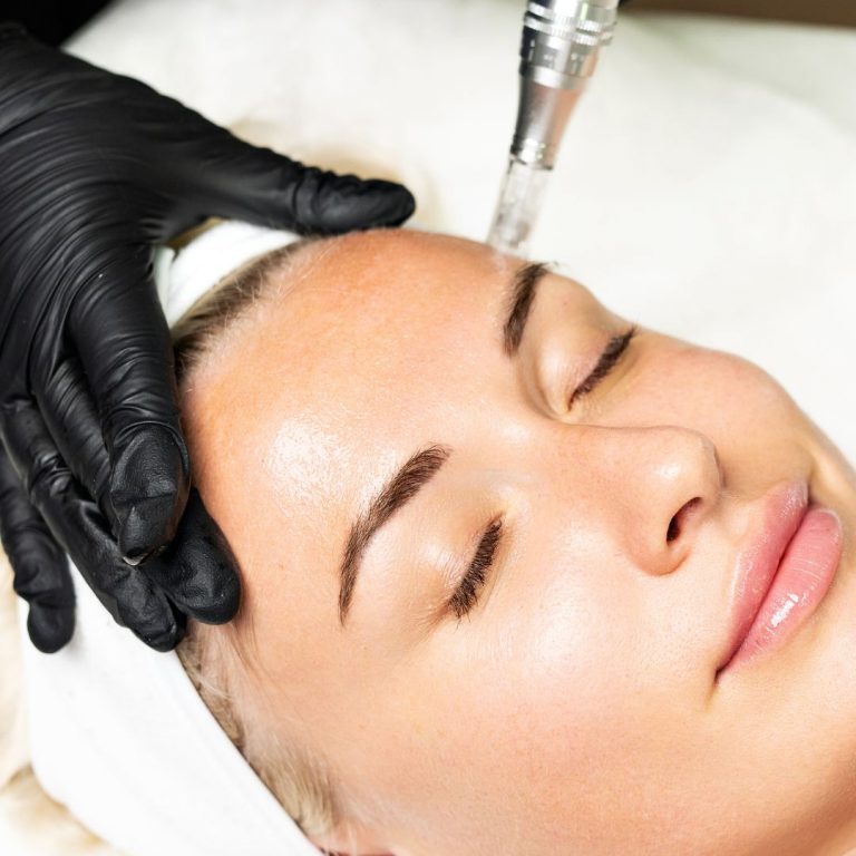 microneedling